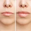 Enhance Your Smile with with 1ml or 2ml Dermal Fillers at True Wellness MedSpa (Up to 30% Off)