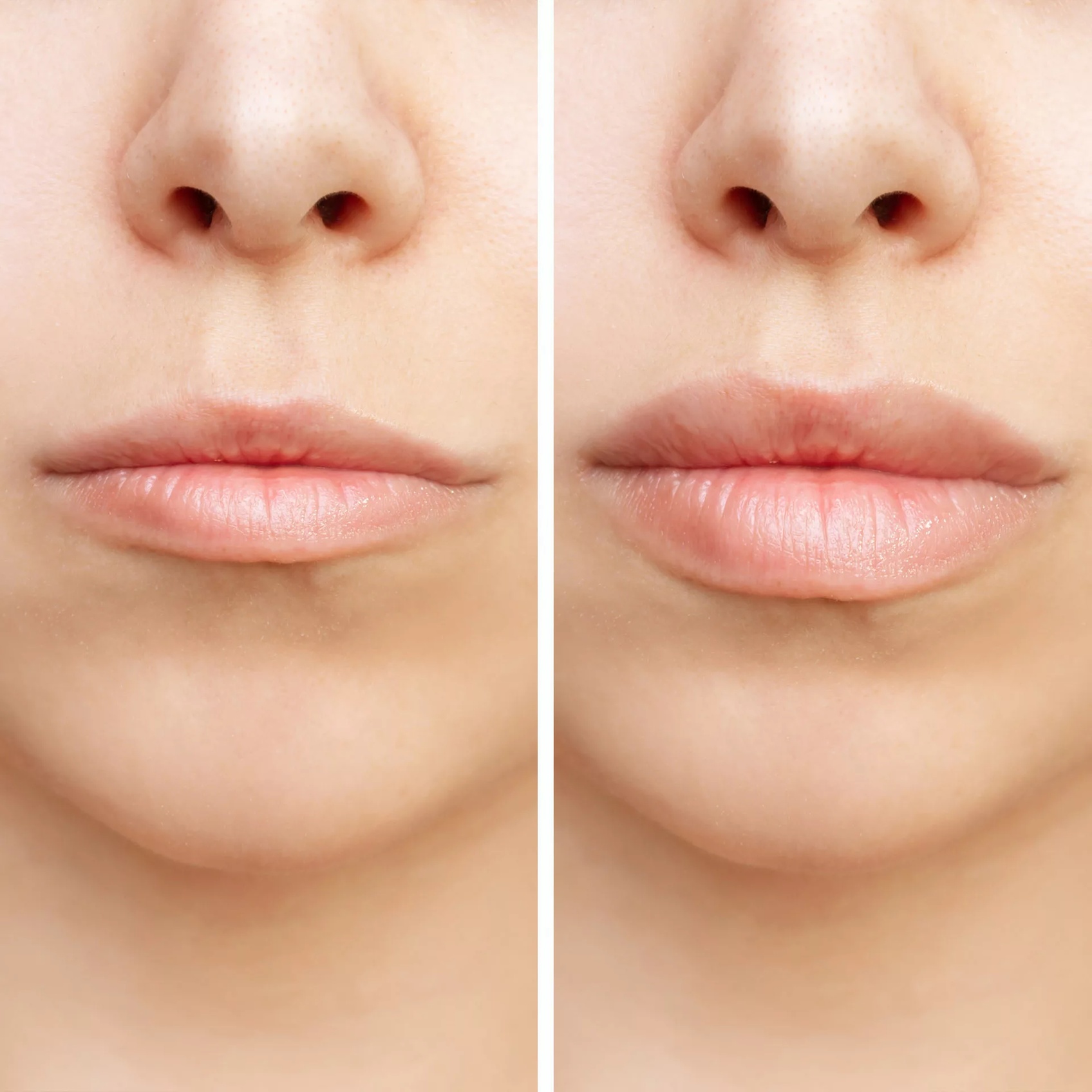 Achieve Plump Lips with 1ml or 2ml Dermal Fillers