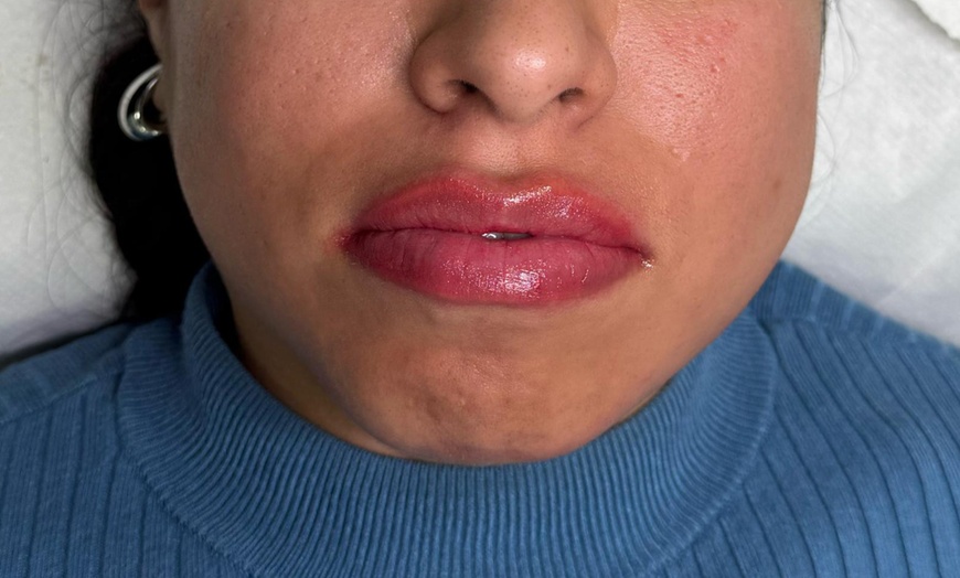 Image 7: Hidratación de labios efecto volumen con hyaluron pen