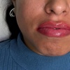 Image 7: Hidratación de labios efecto volumen con hyaluron pen
