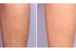 Smooth Skin with Six Sessions of Laser Hair Removal in Small, Medium, Large Areas or Full Body (Up to 69%
Off) - Second Medium