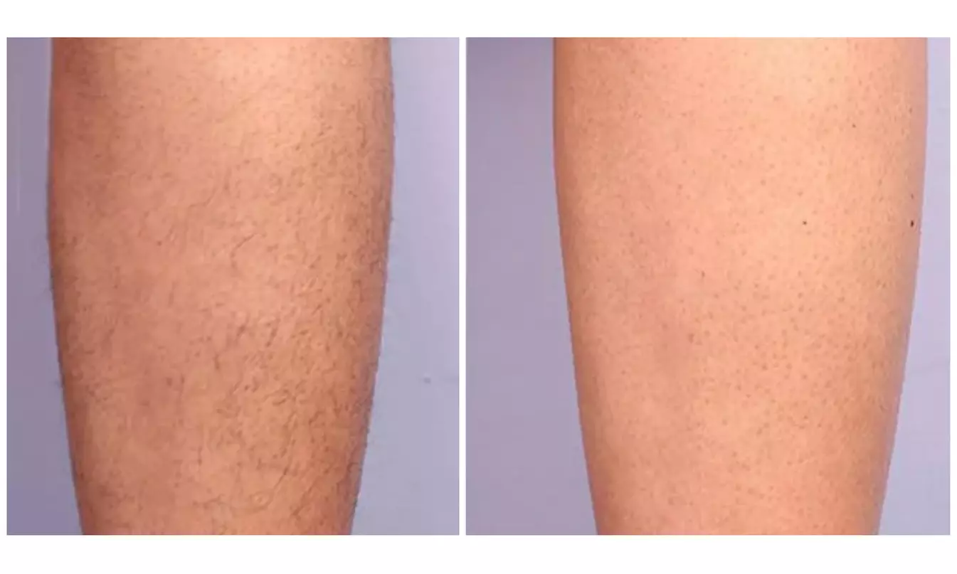 6 Sessions of Laser Hair Removal in Small, Medium, Large Areas & More