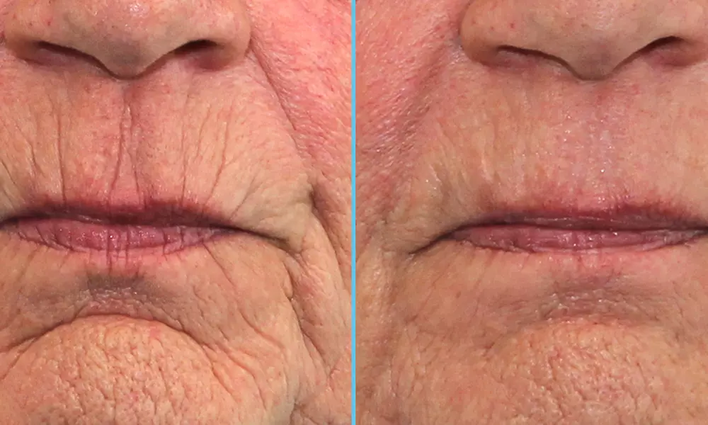 Meta Therapy - 1 Day Advanced Skincare Training & Certification