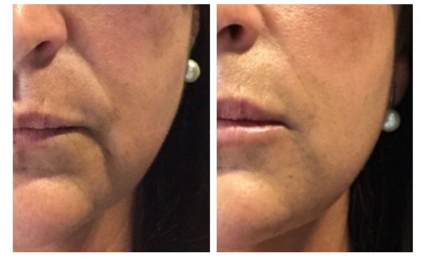 Image 4: Rejuvenate with One HIFU Treatment For Full Face, Neck or Both 