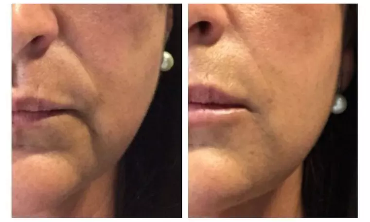 Rejuvenate with One HIFU Treatment For Full Face, Neck or Both