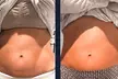 1, 3, or 5 Cryoslimming Body Sculpting Sessions – Fat-Freezing Deals at Wow Recovery Center(Up To 47% Off) - Second Medium