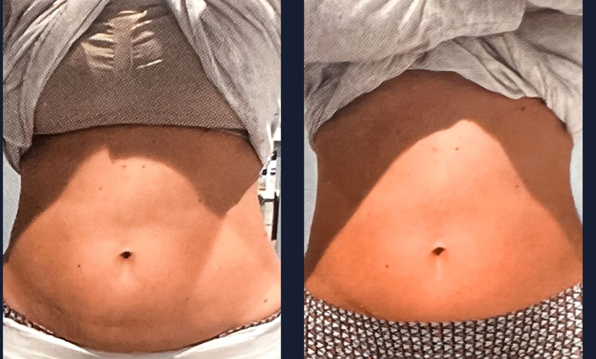 Image 3: Cryoslimming Body Sculpting – 1, 3, or 5 Session Packages