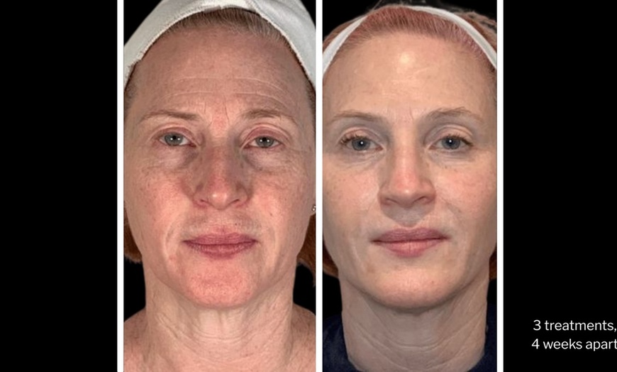 Image 6: Morpheus8 Non-surgical Tightening - Allure Passions Aesthetic Clinic