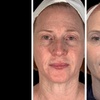 Image 6: Morpheus8 Non-surgical Tightening - Allure Passions Aesthetic Clinic