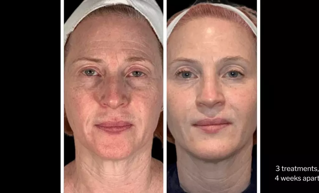 Morpheus8 Non-surgical Tightening - Allure Passions Aesthetic Clinic