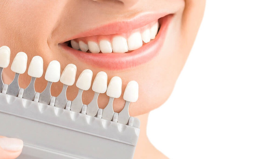 Image 2: Carillas dentales de composite con diseño digital de sonrisa