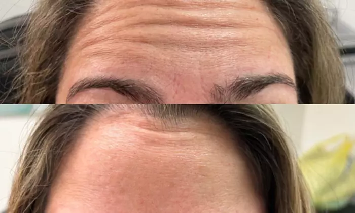 Revitalize with 20, 40, or 60 units Units of Jeuveau