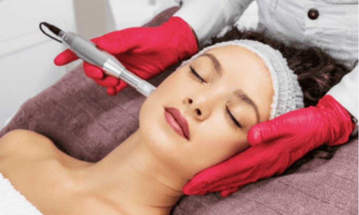 Achieve Radiant Skin with One or Two Microneedling Treatments