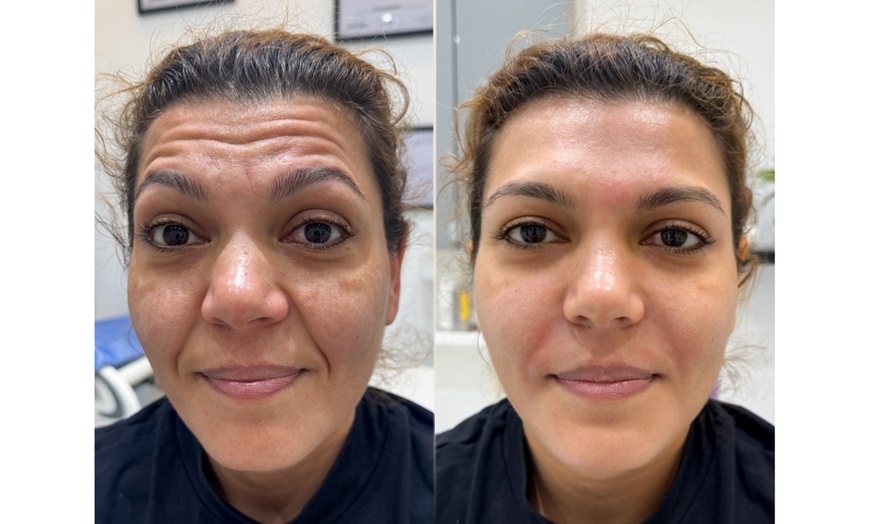 Image 3: Subtle to Full-Face Enhancements with 1ml, 2ml, or 3ml Dermal Filler 