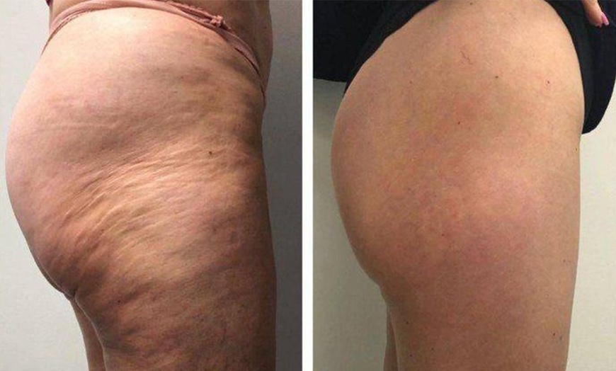 Image 2: Refresh with Full body Endosphere treatment (60 min) 