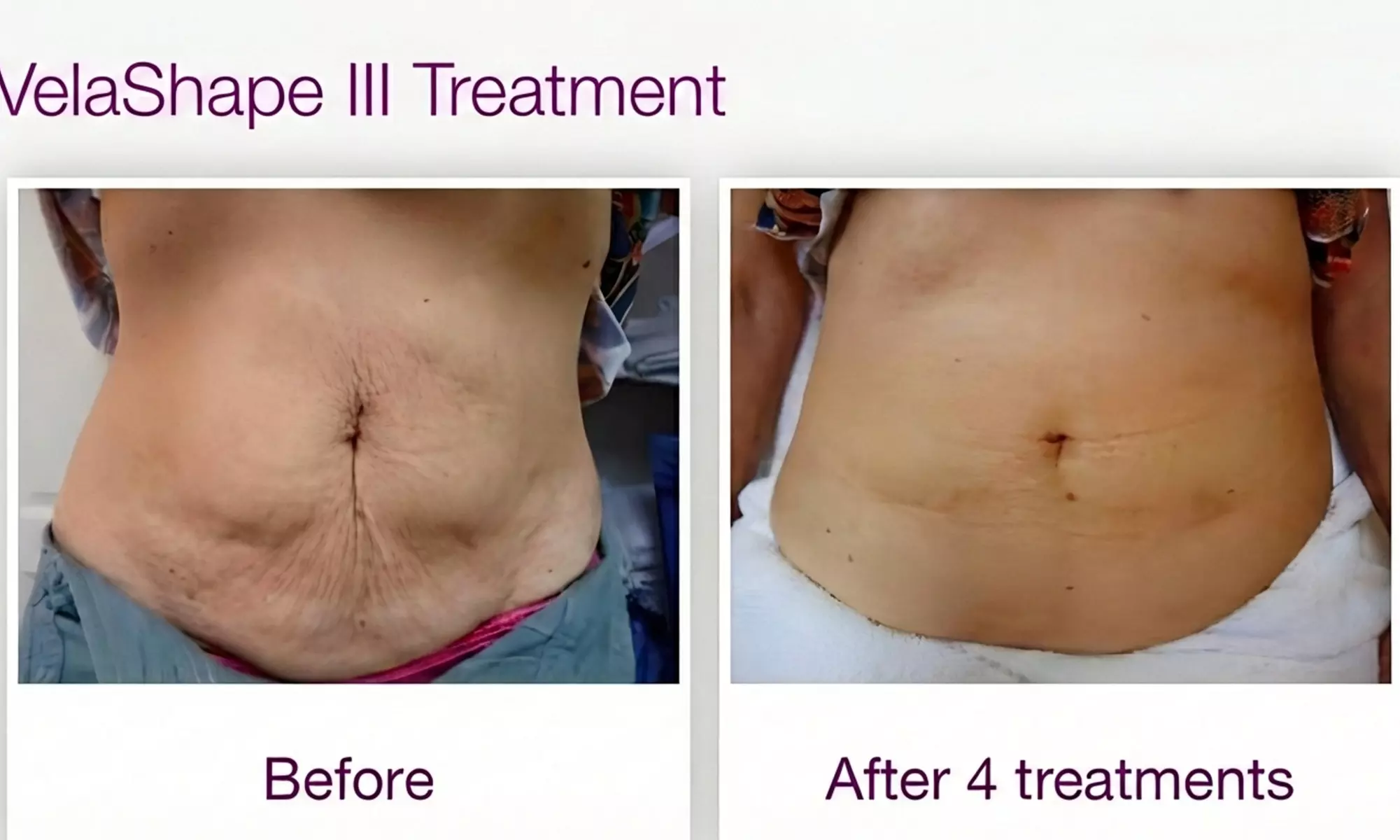 VelaShape Sessions for Targeted Body Contouring & Cellulite Reduction