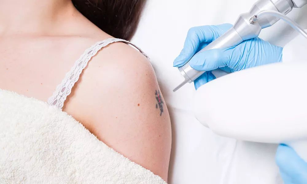 3 o 6 sesiones de eliminación de tatuajes con láser, hasta 25 o 50 cm²