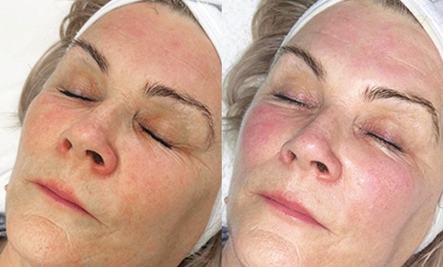 Image 3: HydraFacial with Optional Radio Frequency for Hydrated & Radiant Skin