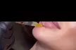 Enhance Your Lips with Lip Filler - Half or Full Syringe at Ora Wellness and Aesthetics (Up to 22% Off) - Second Medium