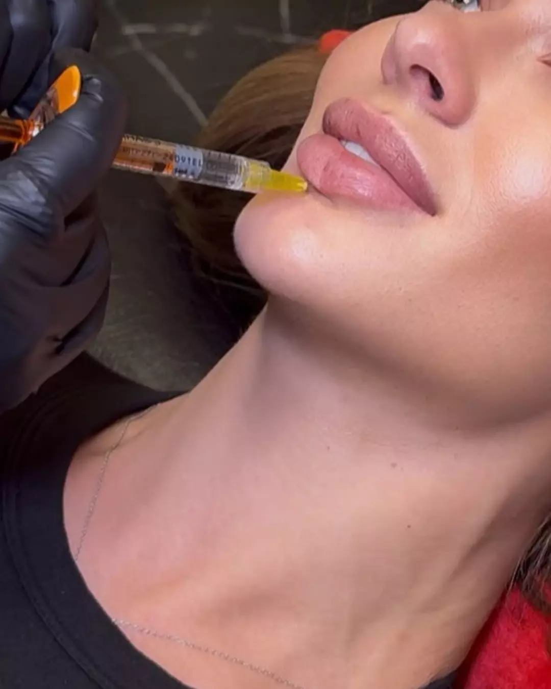Enhance Your Lips with Lip Filler - Half or Full Syringe 