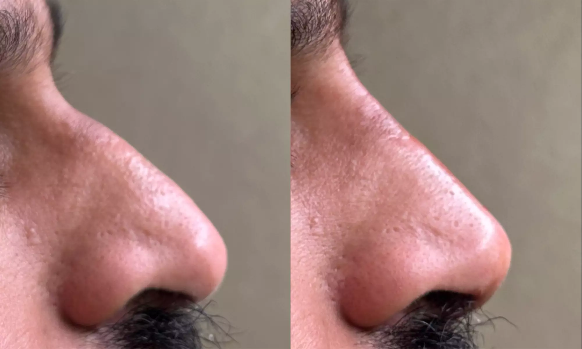 Enhance Your Natural Beauty with Dermal Filler Treatments