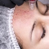 Image 1: Microneedling mit Maske und optionaler Gesichtsbehandlung  & Reinigung