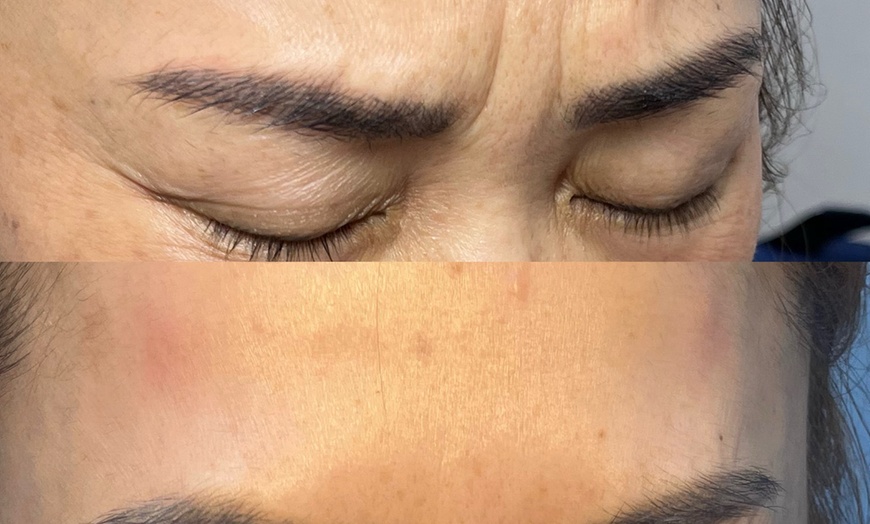 Image 6: Refresh Your Skin with 20, 40, or 60 Units of Neurotoxin
