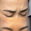 Image 6: Refresh Your Skin with 20, 40, or 60 Units of Neurotoxin