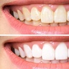 Image 5: Brighten Your Smile with Laser Teeth Whitening in Soho