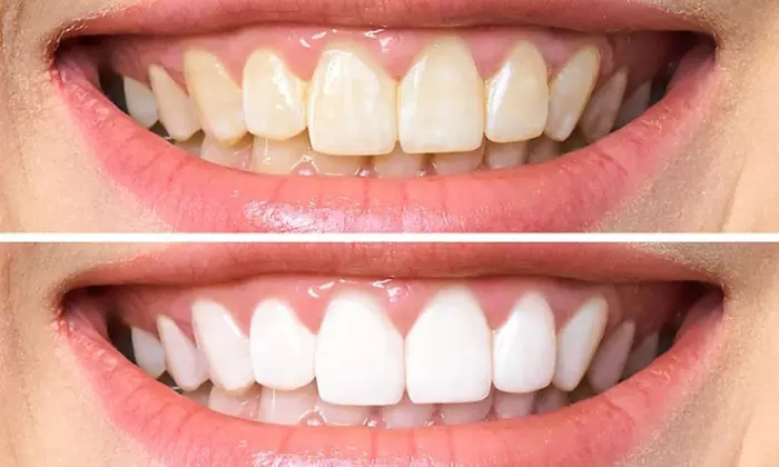 Brighten Your Smile with Laser Teeth Whitening in Soho