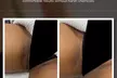 Discreet and Effective Intimate Bleaching at W Laser: Up to 40% Off Intimate Bleaching - Second Medium