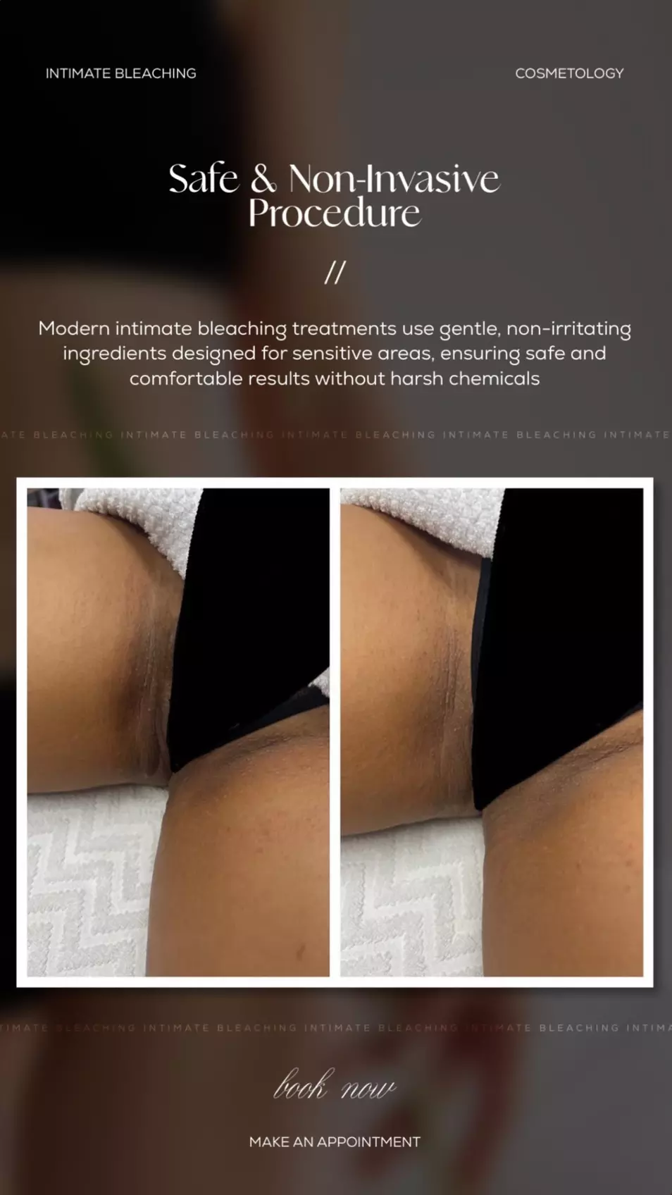 Discreet and Effective Intimate Bleaching at W Laser