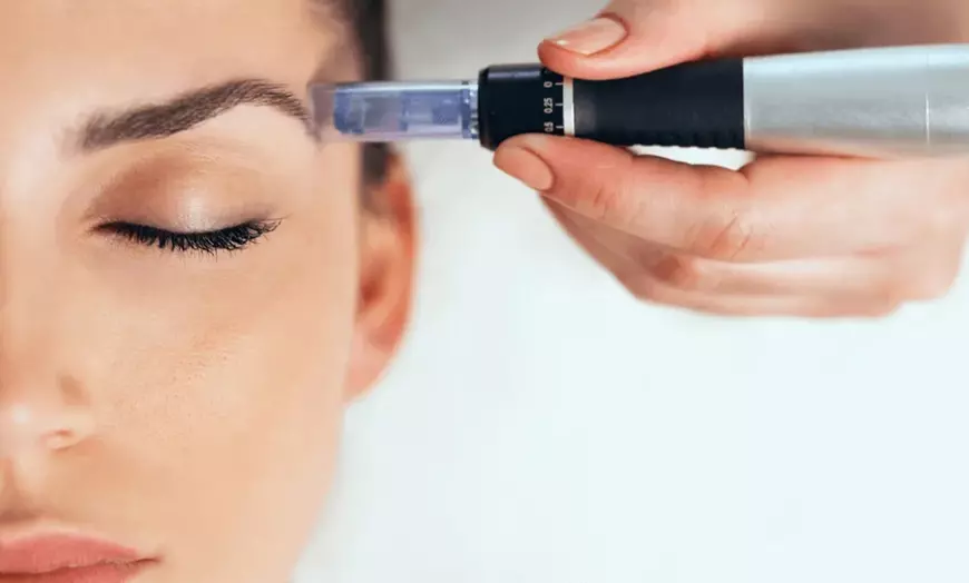 Image 1: Exosomas con dermapen en rostro completo