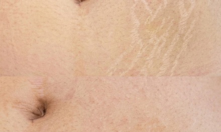 Scar Treatment - Inkless or Camouflage; Small to Medium Size; Monday-Saturday - Beautifully Renewed