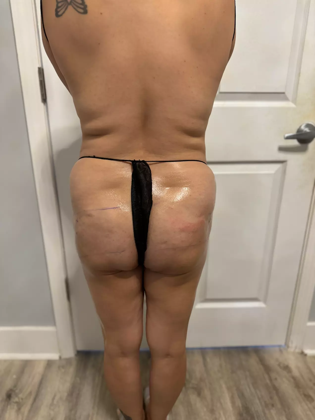 Non-Invasive Laser Lipo: Choose from Four or Six Sessions