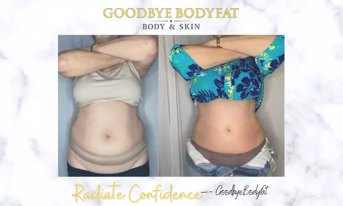 Radio-Frequency Lypolysis Sessions at Goodbye BodyFat