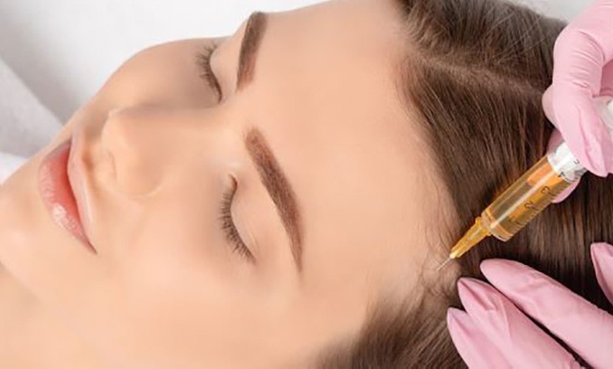 Image 3: PDO Thread Lifts for Mid-Face/Jawline Area with One Barbed Thread/Side