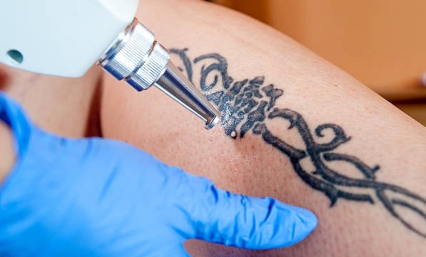 Image 1: Eliminación de micropigmentación o tatuajes con láser 