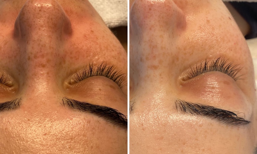 Image 9: Microneedling-Behandlung oder Enzym-Lifting-Paket für 1 Person