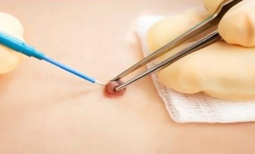 Image 2: Efficient Mole Removal & 15 Min Skin Tag Treatment + Laser Precision