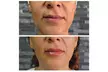 IPL Sessions for Face or Face & Neck to Rejuvenate Skin at Phoenix Laser And Rejuvenation Center (Up To 78% Off) - Second Medium
