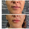 Image 2: IPL Sessions for Face or Face & Neck 