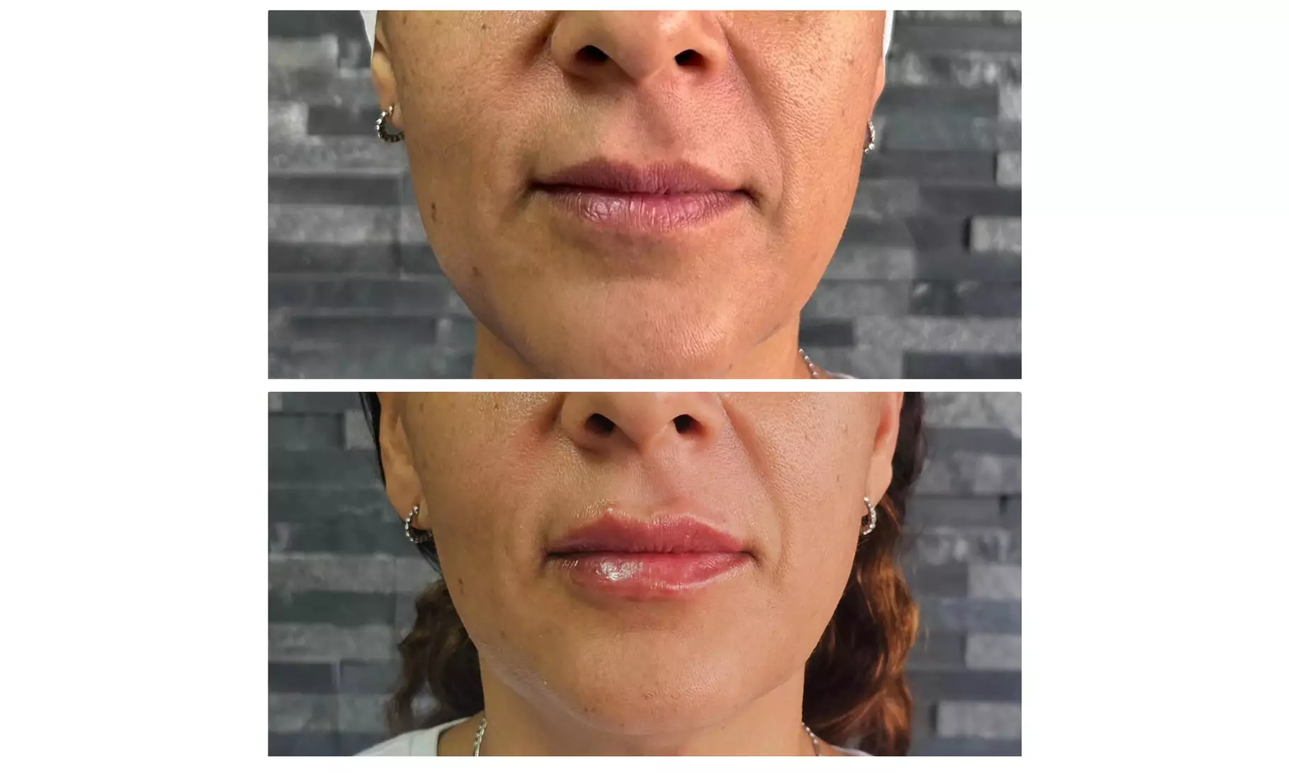 IPL Sessions for Face or Face & Neck