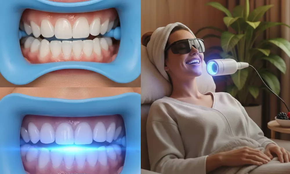 1 ou 2 séances de blanchiment dentaire de 20 ou 60 min