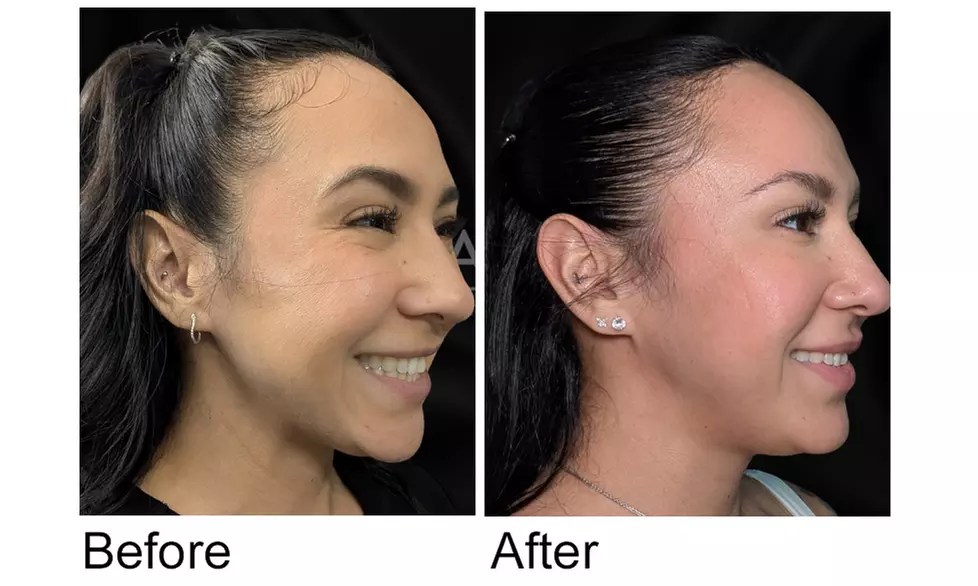 Get Relief from Excessive Sweating and Migraines with Neurotoxin Treatment at ActIVate Drip Spa (Up to 40%Off) - Second Medium