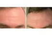 Target Deeper Wrinkles with 20, 40, or 60 Units of Botox at Essential Aesthetics - Up to 17% Off - Second Medium