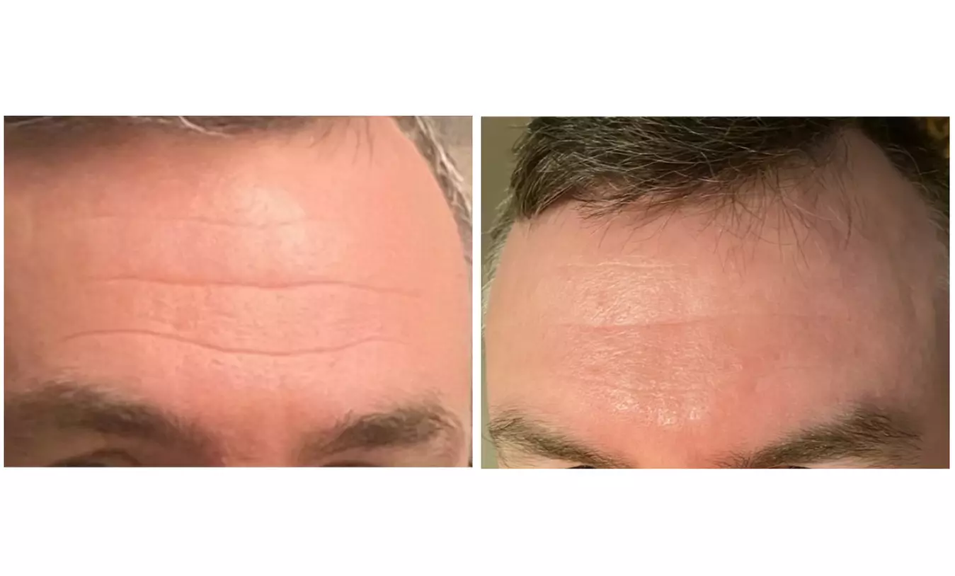 Target Deeper Wrinkles with 20, 40, or 60 Units of Botox