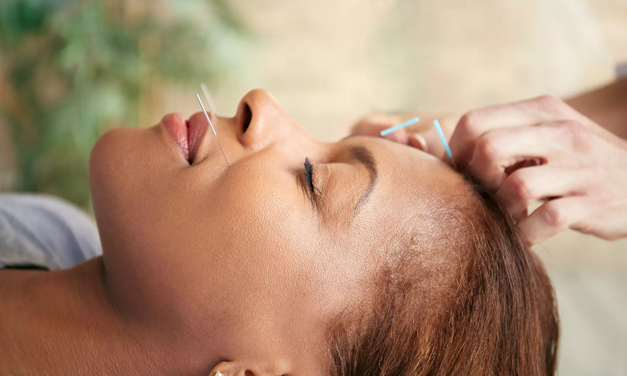 Acupuncture at Belle View Massage Therapy And Wellness Center (Up to 64% Off). Two Options Available.  - Primary Image