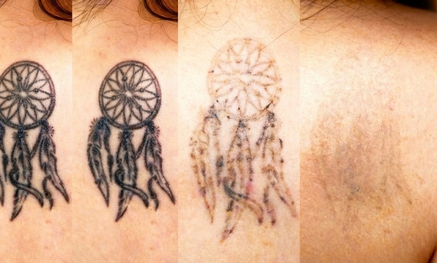 Image 2: One Laser Tattoo Removal Treatment Session for Up to 7 or 12 Sq Inches