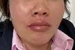 Perfect your look with 1 or 1.5 Syringe Restylane Kysse Lip Filler + Optional 20 Units Xeomin (Up to 56% Off) - Second Medium